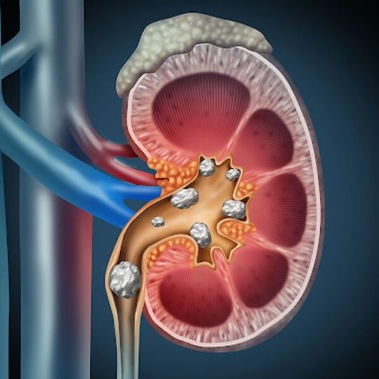 kidney stones